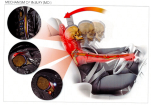 Al Vangura Injury Head Trauma